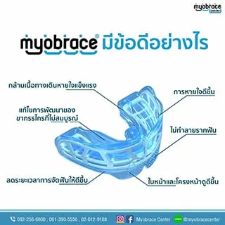 ข้อดีของ MYOBRACE